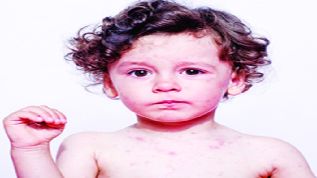 Baby health care | heat rash | protect in summer and rainy days |