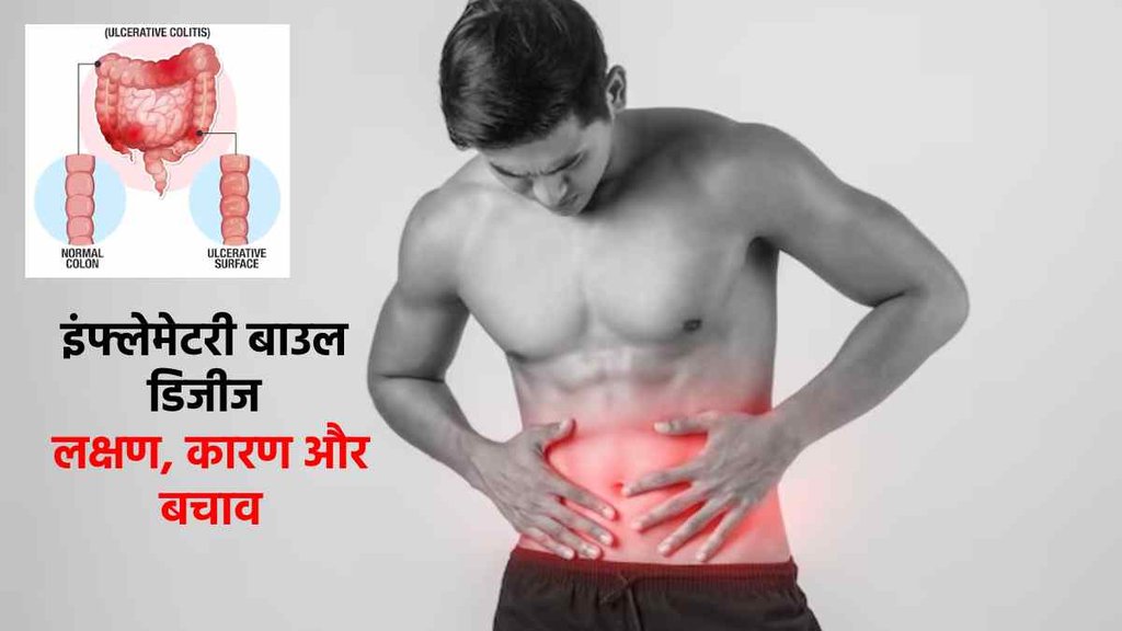 Inflammatory Bowel Disease। IBD Symptoms। IBD Causes। IBD Medical Test