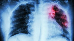 Tuberculosis | prisioner