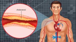नसों की दीवार सड़ा रहा है High Cholesterol, रोजाना कर लें इन 3 मसालों का सेवन, जल्द ही नीचे ला देंगे बैड कोलेस्ट्राल