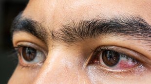 pink eye prevention, pink eye treatment, eye flu in delhi after flood, conjunctivitis eye, conjunctivitis eye treatment, how to cure pink eye at home fast,