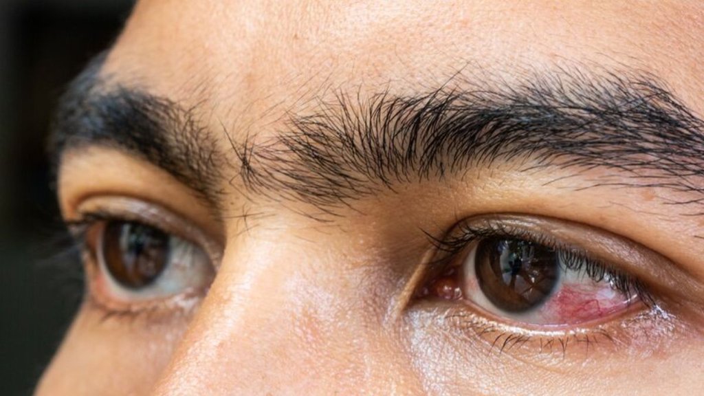pink eye prevention, pink eye treatment, eye flu in delhi after flood, conjunctivitis eye, conjunctivitis eye treatment, how to cure pink eye at home fast,