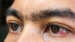 लाल गुलाबी भारी आंखें,आईज में सूजन और पानी निकलना Eye Flu के हैं लक्षण, ये संक्रमण देखने से नहीं बल्कि टच करने से फैलता है, इस तरह करें बचाव