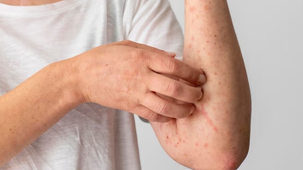 Monsoon, Rain, Tips to prevent fungal and bacterial infections