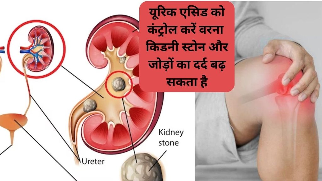relief from joint pain,uric acid stone, uric acid stone symptoms, uric acid stone cure, uric acid, uric acid control tips