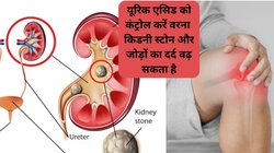 Uric Acid का स्तर हाई होने से बढ़ सकता है Kidney Stone का खतरा, एक्सपर्ट के इन 10 टिप्स को अपनाएं, गुर्दों की पथरी के साथ ही जोड़ों के दर्द की भी होगी छुट्टी