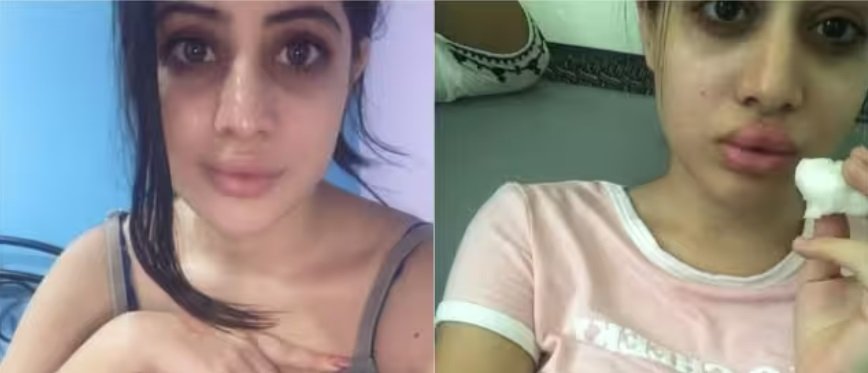 uorfi javed| uorfi lip fillers| urfi javed botox