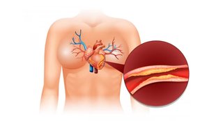 natural remedies to reduce cholesterol, home remedies to lower cholesterol naturally, How to use Arjun Ki Chaal to reduce cholesterol,