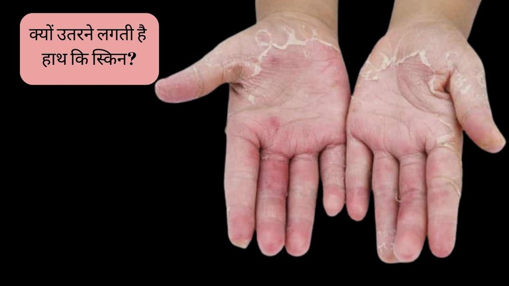 Hand Skin Peeling । Hand Skin Peeling Cause । Hand Skin Peeling Treatment । hand peeling treatment । hand peeling causes