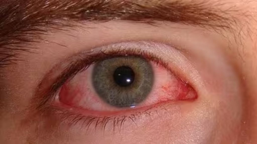 Eye Flu । Who are at higher risk Of Eye Flu । Pink Eye Causes । Conjunctivitis Treatment । monsoon eye flu