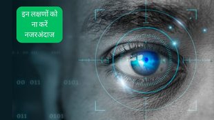 Glaucoma । Glaucoma in hindi । Glaucoma Symptoms । glaucoma treatment