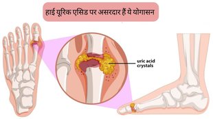 Yoga For Uric Acid । yoga to reduce uric acid । yoga poses for High uric acid