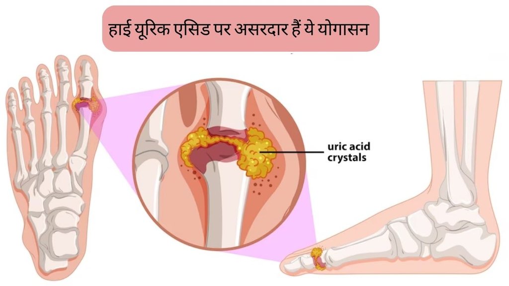 Yoga For Uric Acid । yoga to reduce uric acid । yoga poses for High uric acid