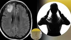 महिला को थी पेट दर्द, दस्त, खांसी, बुखार जैसी समस्या, डॉक्टरों ने चेक किया तो दिमाग में मिला रेंगता कीड़ा; हर कोई है हैरान