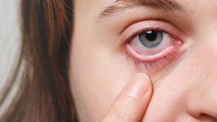 How can I treat eye flu at home, आई फ्लू के घरेलू उपाय, आई फ्लू के लक्षण और बचाव, आई फ्लू का इलाज कैसे करें