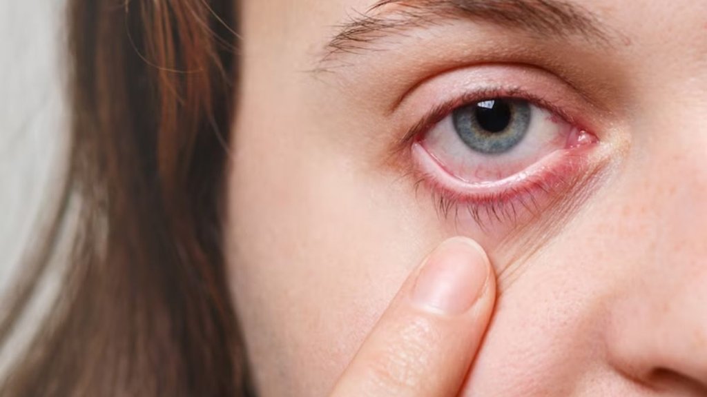 How can I treat eye flu at home, आई फ्लू के घरेलू उपाय, आई फ्लू के लक्षण और बचाव, आई फ्लू का इलाज कैसे करें