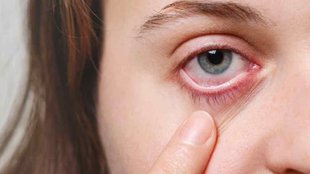 Eye Flu Astro Treatment | Eye Flu Ke Vedic Upay। Grah for eye Problems।