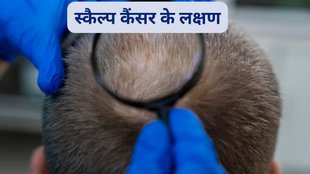 scalp,cancer,स्कैल्प कैंसर,स्कैल्प कैंसर के लक्षण