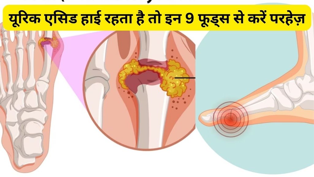 uric acid cause and home remedies, how to control purine intake, यूरिक एसिड, यूरिक एसिड बढ़ने का कारण