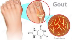कुछ लोगों का हमेशा Uric Acid का स्तर क्यों रहता है हाई? क्या है कारण और उसे नॉर्मल करने का तरीका