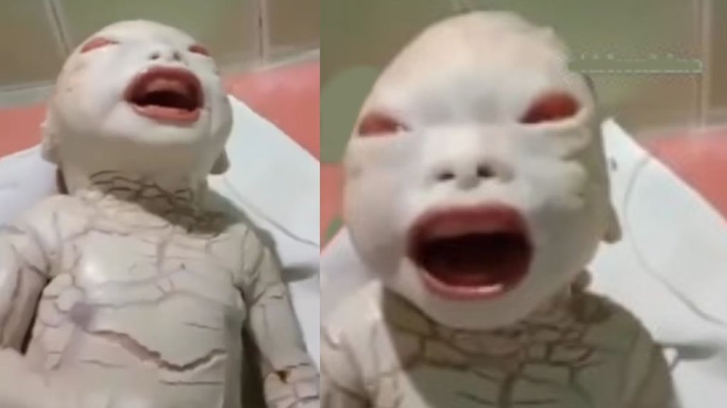 Harlequin ichthyosis । Harlequin-type ichthyosis । Harlequin Baby