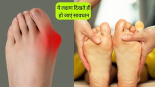 Psoriatic Arthritis । Psoriatic Arthritis Symptoms । Psoriatic Arthritis Treatment