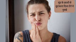 Mouth Ulcers Remedies: मुंह में छालों ने मुश्किल कर दिया है कुछ भी खाना पीना? अपना लें ये 3 आसान तरीके, एक रात में दूर हो जाएगी परेशानी
