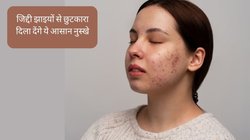 जिद्दी झाइयों ने छीन ली है चेहरे की रंगत? आज ही अपना लें ये देसी नुस्खे, महंगी क्रीम्स की नहीं पड़ेगी जरूरत