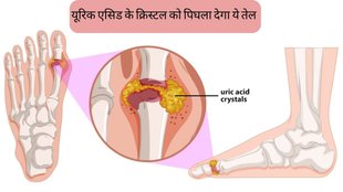 Uric Acid । olive oil to treat joint pain । joint pain