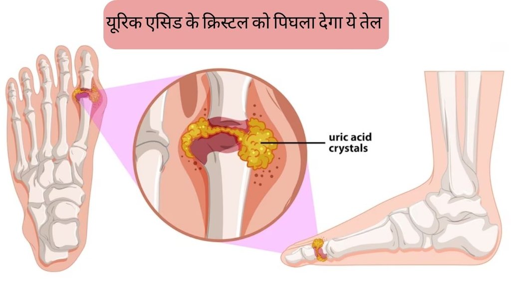 Uric Acid । olive oil to treat joint pain । joint pain