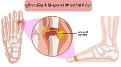 Uric Acid Remedies: हड्डियों में जमा यूरिक एसिड के क्रिस्टल को पिघलाकर पेशाब के रास्ते बाहर कर देगा ये तेल, दोबारा नहीं होगी जोड़ों में दर्द-सूजन की शिकायत