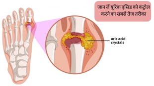 Uric Acid Treatment । Uric Acid । Gout । Kidney stone