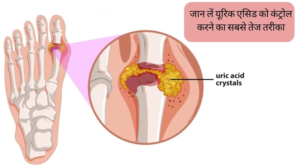 Uric Acid Treatment । Uric Acid । Gout । Kidney stone