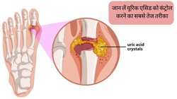 Uric Acid Treatment: ये है यूरिक एसिड को कंट्रोल करने का सबसे तेज तरीका, हमेशा के लिए छूड़ा देगा जोड़ों के दर्द से पीछा, गाउट-पथरी से भी होगा बचाव