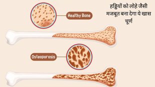 Osteoporosis । World Osteoporosis Day 2023 । Osteoporosis Treatment