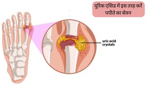 Papaya For Uric Acid । Uric Acid । Uric Acid Treatment