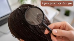 Dandruff Remedy । Hair Care । Dandruff Treatment