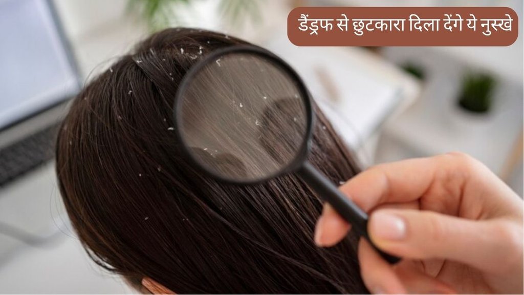 Dandruff Remedy । Hair Care । Dandruff Treatment