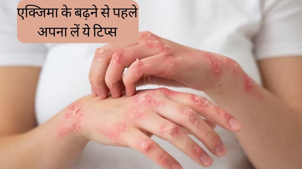 Eczema । Eczema Treatment । Eczema Cause । Skin Infection