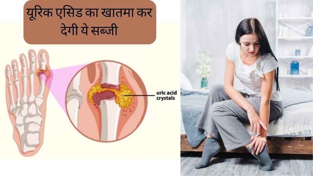 Uric Acid । Uric Acid Remedies । Uric Acid Home Remedies