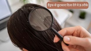 Dandruff Remedy । Hair Care । Dandruff Home Remedies