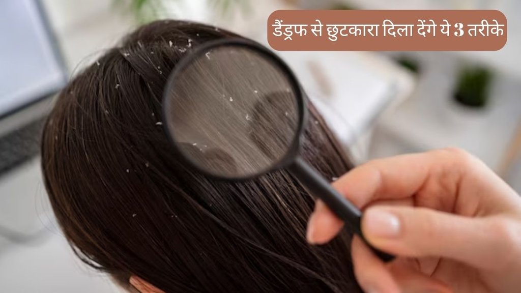 Dandruff Remedy । Hair Care । Dandruff Home Remedies