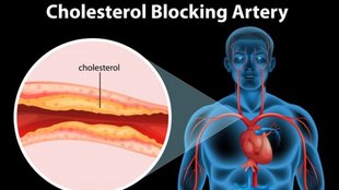 LDL cholesterol levels, medibuddy study, good cholesterol, blood pressure,कोलेस्ट्रॉल कंट्रोल करने वाले फूड्स,गुड कोलेस्ट्रॉल कैसे बढ़ाएं