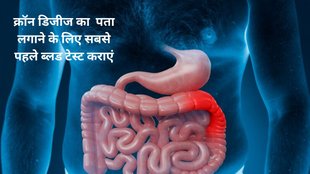 crohn’s disease signs and symptoms,क्रॉन डिजीज के लक्षण, क्रोन डिजीज के लक्षणों की पहचान कैसे करें,
