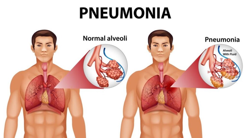 Pneumonia China,pneumonia causes prevention and treatment,pneumonia control,pneumonia and lung health,White Lungs Pneumonia, व्हाइट लंग्स निमोनियां के लक्षण