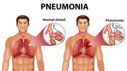 Pneumonia Diet: निमोनिया से राहत पाने में मदद करते हैं ये 4 फूड्स, डाइट में करें शामिल, तेजी से होगी रिकवरी