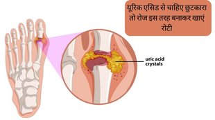 Uric Acid । Uric Acid Treatment । Uric Acid Remedies