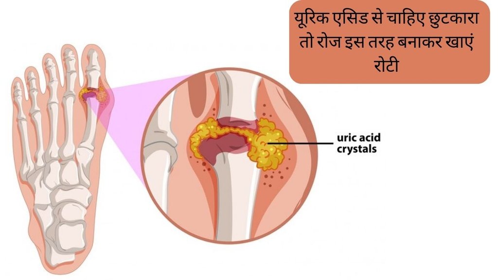 Uric Acid । Uric Acid Treatment । Uric Acid Remedies
