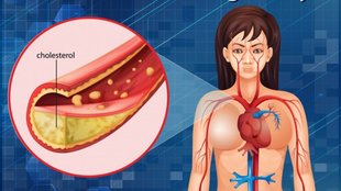High Cholesterol Diet । Cholesterol Food । heart attack