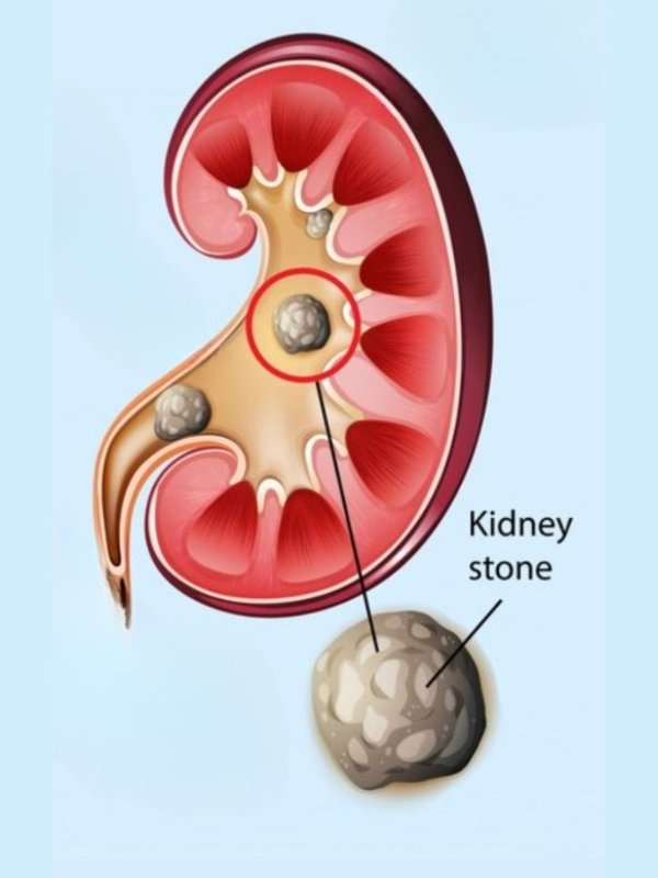 Kidney stone । kidney stones । kidney stone Treatment